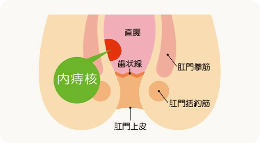 内痔核