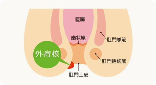 外痔核