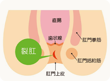 裂肛（切れ痔）