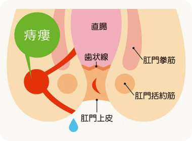 穴痔（痔ろう）