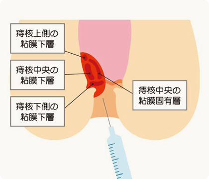 ジオン注(ALTA)治療