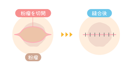 粉瘤手術