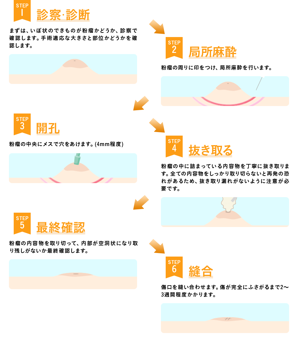 粉瘤手術の流れ